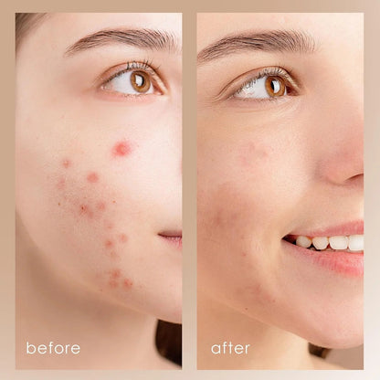 Limpiador Facial Ultrasónico Peeling – Limpieza Profunda - detalle